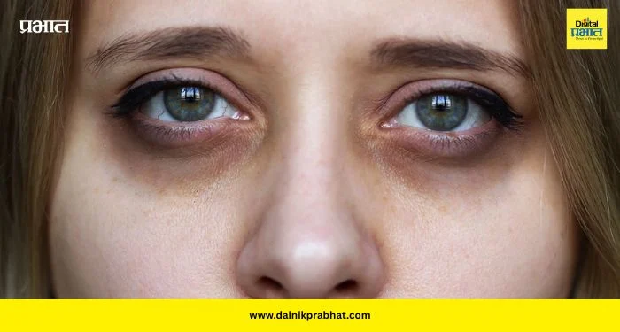 Dark circles: डार्क सर्कल्सची खरी कारणे उघड! झोपेव्यतिरिक्त या ५ गोष्टींमुळे वाढते समस्या