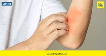 Liver Health: त्वचेवर दिसतायत ‘ही’ लक्षणं? दुर्लक्ष करू नका; लिव्हरच्या आजाराचा असू शकतो इशारा
