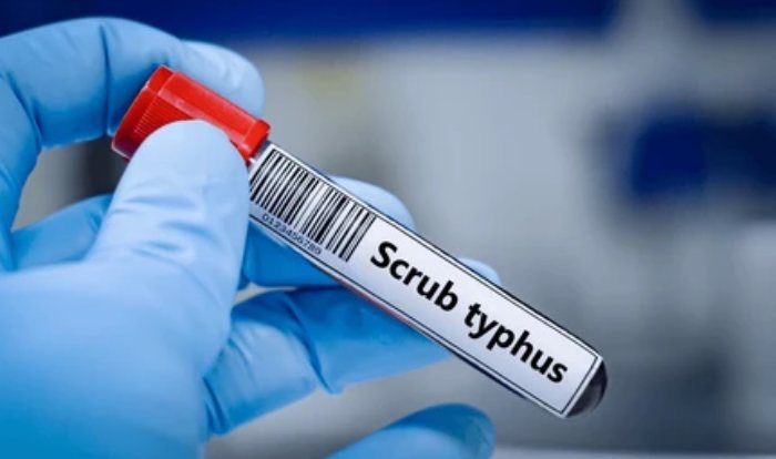 Scrub typhus : पावसाळ्यात वाढतोय स्क्रब टायफसचा धोका; घाबरू नका, वेळीच घ्या वैद्यकीय सल्ला!