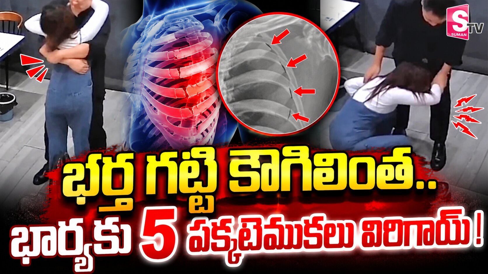 భర్త గట్టి కౌగిలింత.. భార్యకు విరిగిన పక్కటెముకలు..!